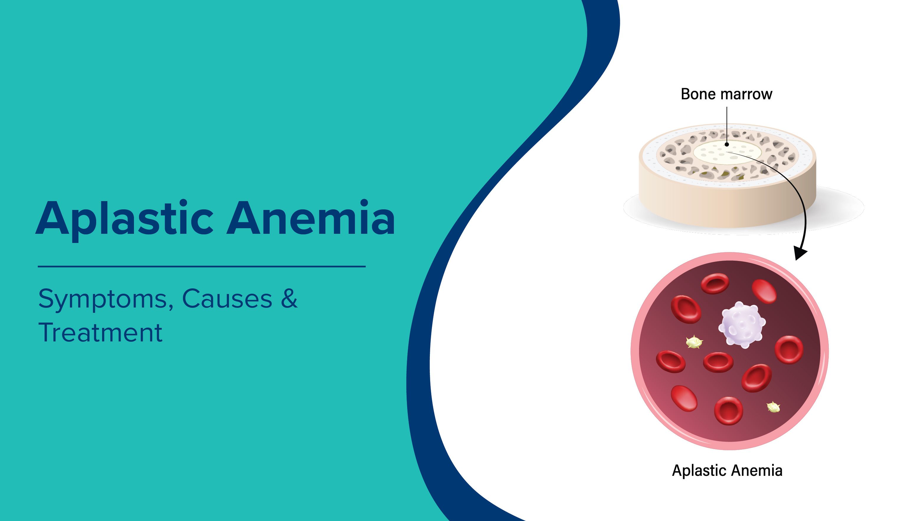 Aplastic Anemia: Symptoms, Causes & Treatment