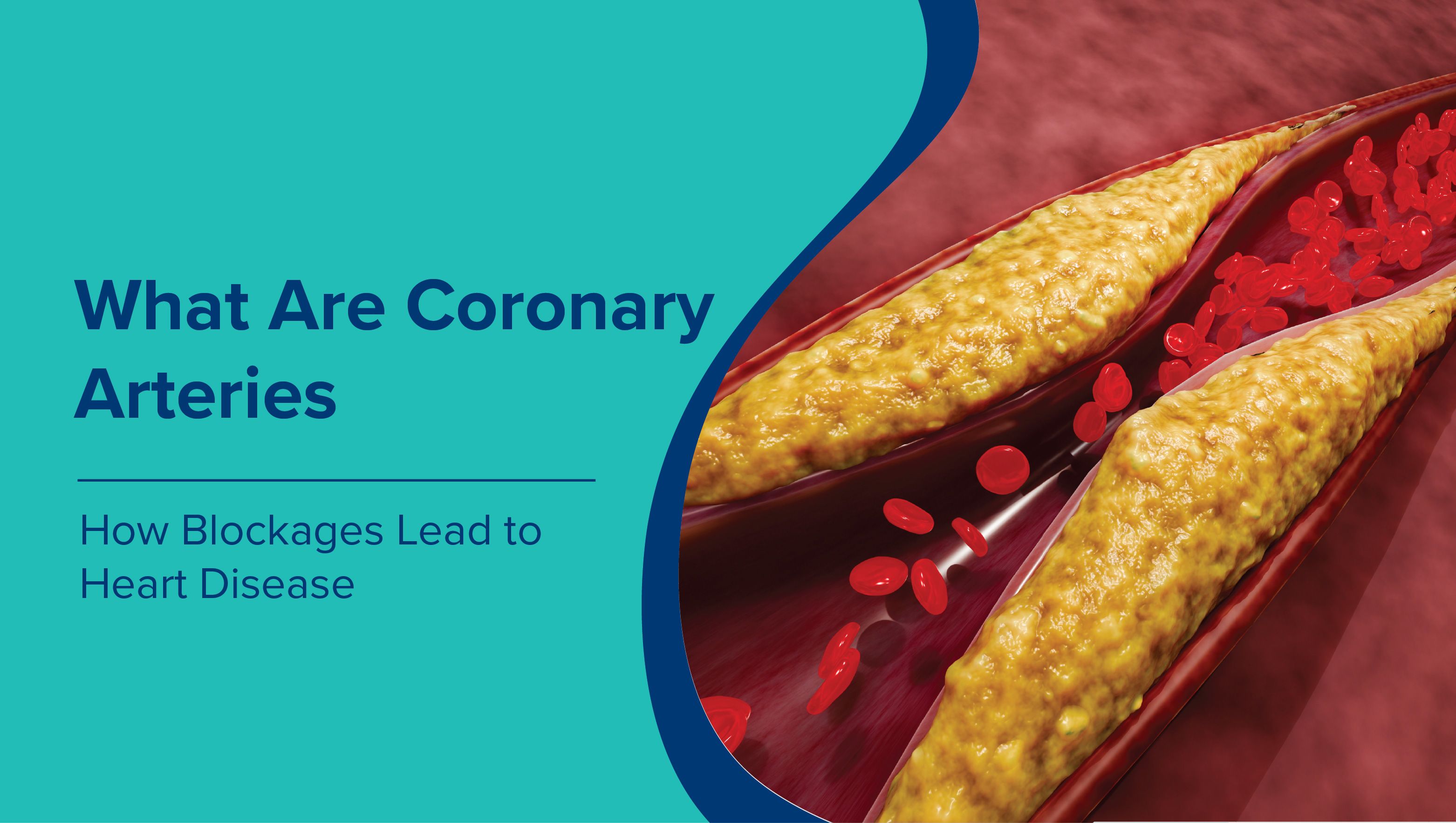 What Are Coronary Arteries? How Blockages Lead to Heart Disease