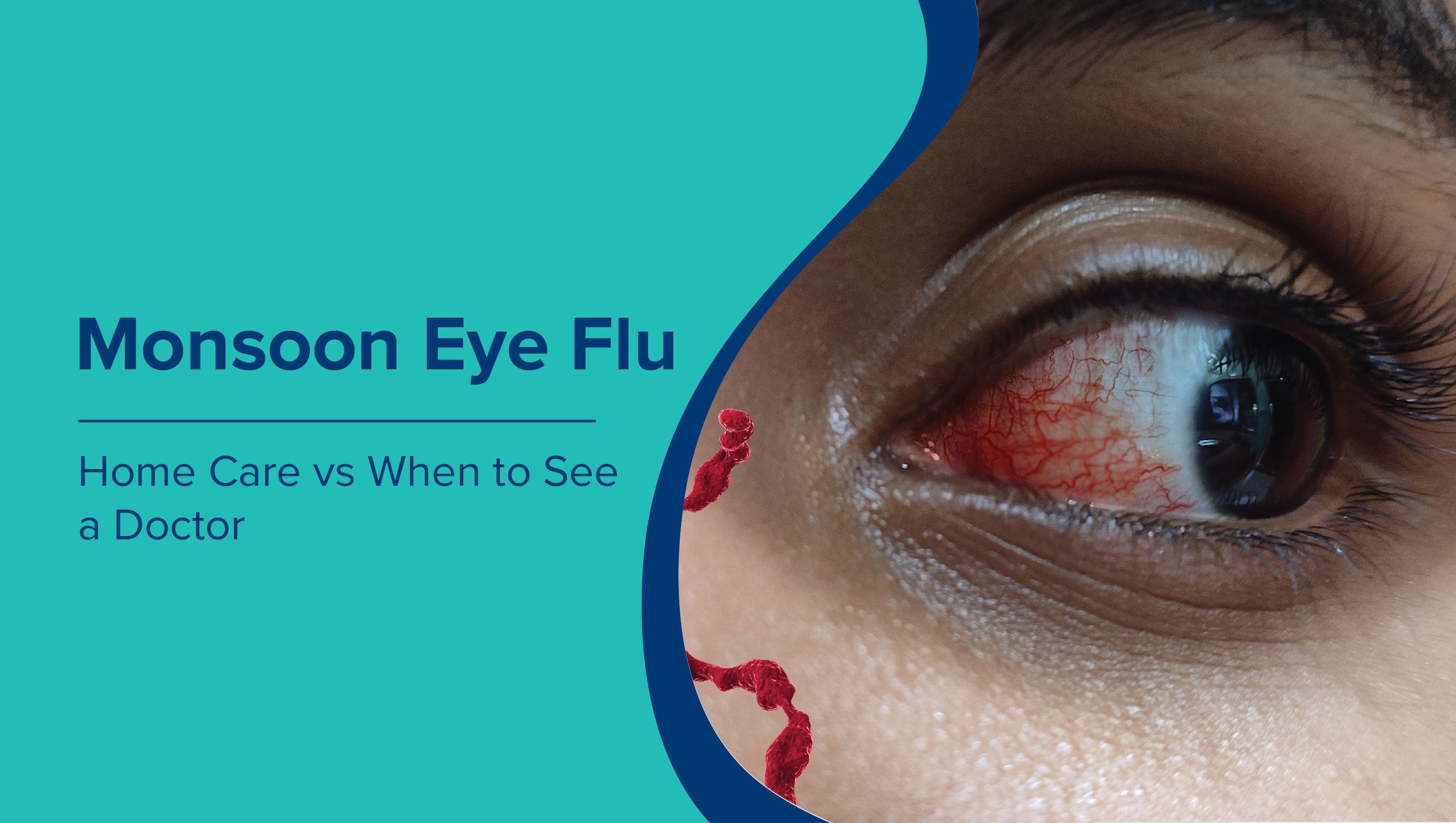 Monsoon Eye Flu: Home Care vs When to See a Doctor