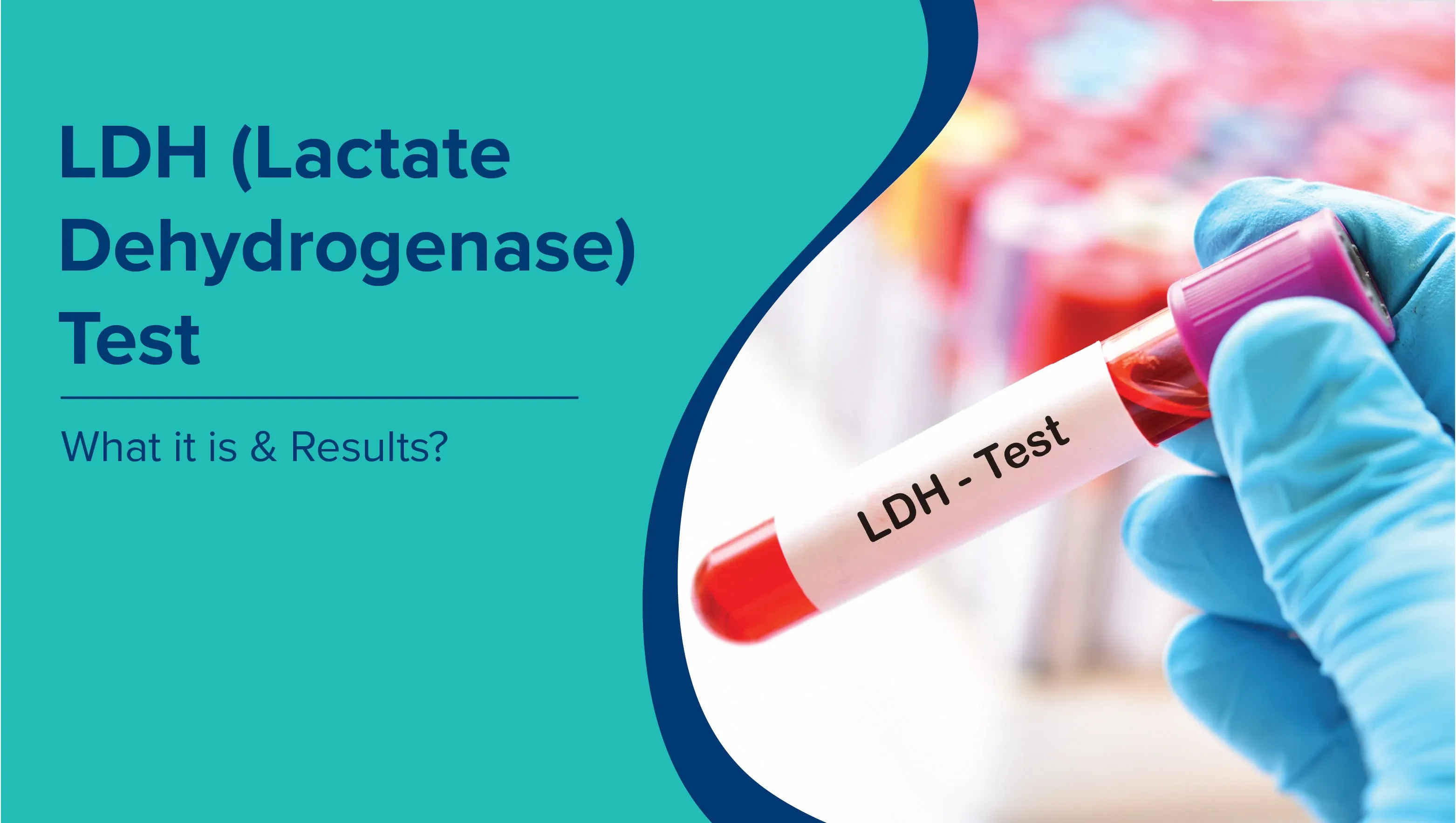 LDH (Lactate Dehydrogenase) Test: What It Is & Results