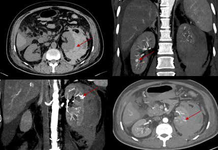polyarteritis_figure_1