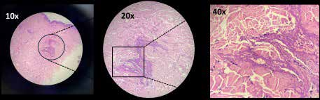 polyarteritis_figure_2