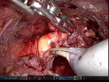 Robotic_Surgery_fig_6