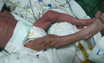 Symptomatic_figure_2_a