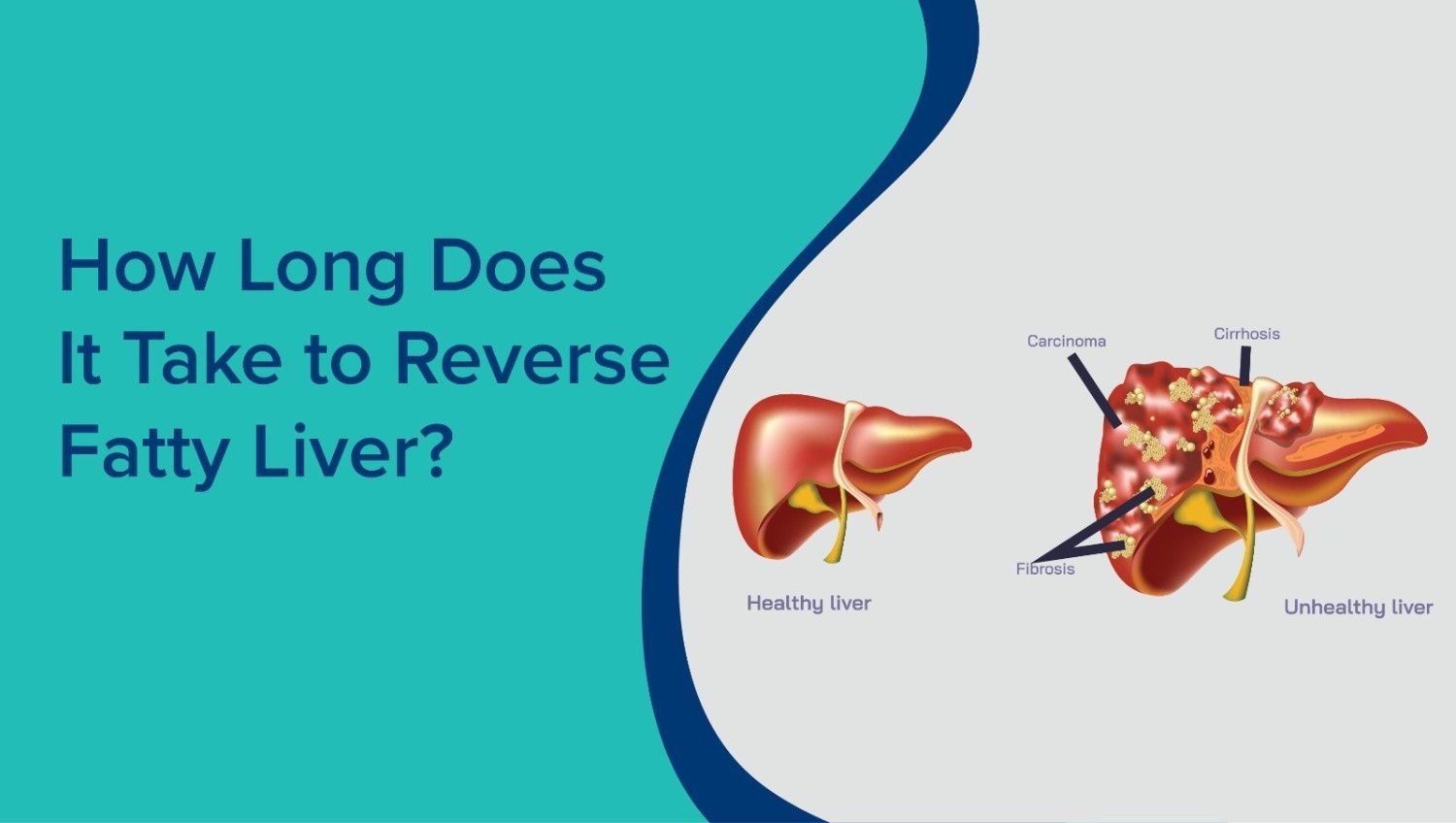 How Long Does It Take to Reverse Fatty Liver