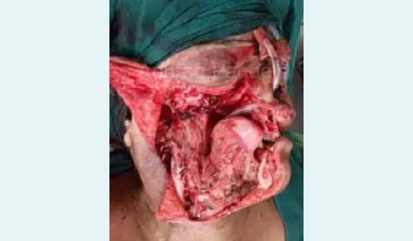 Front view — Post excision defect