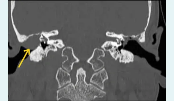 High-resolution computed tomography 