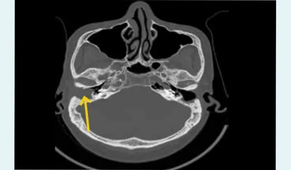 High-resolution computed tomography