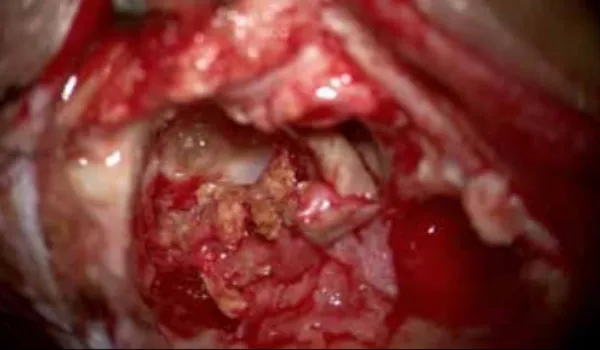 Cyst wall of cholesterol granuloma.