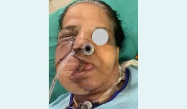 Front view (Day 5) — Reconstruction with free anterolateral thigh (ALT) flap.