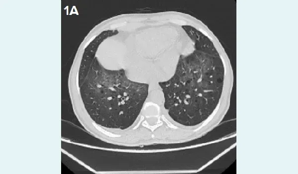 High-resolution computed tomography