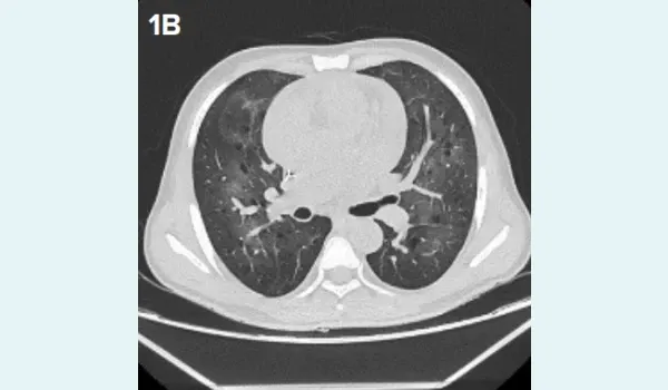 High-resolution computed tomography