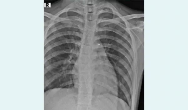 Normal chest X-ray