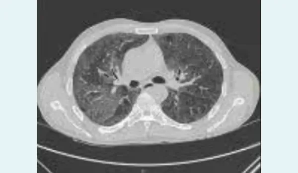  Patchy and confluent