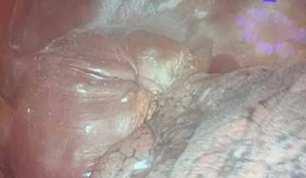 Intra-operative view after diaphragmatic plication and talc pleurodesis.