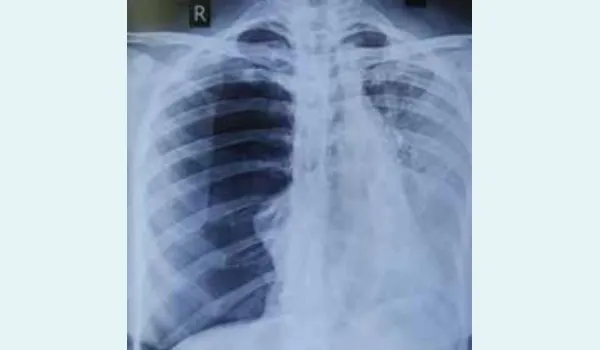 Right-sided pneumothorax with complete collapse of the underlying right lung.