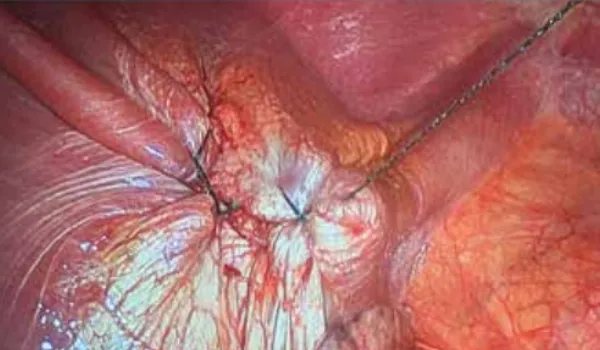 Intra-operative view after diaphragmatic