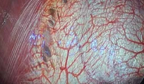Intra-operative view of diaphragmatic fenestrations