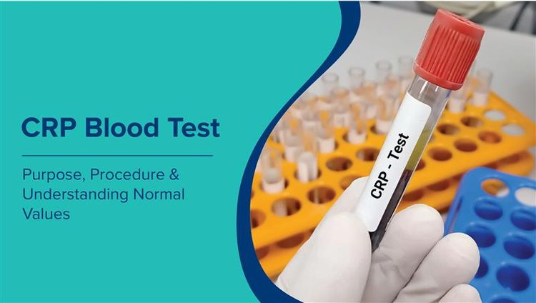 सीआरपी परीक्षण (CRP Test in Hindi): उद्देश्य, प्रक्रिया और सामान्य मानों को समझना