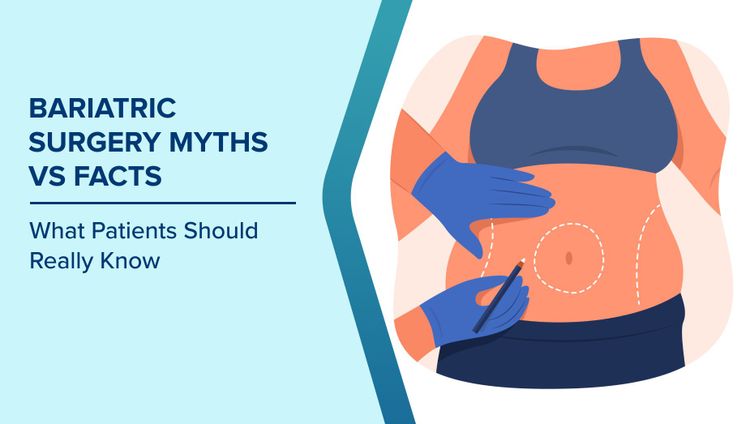 Bariatric Surgery Myths vs Facts
