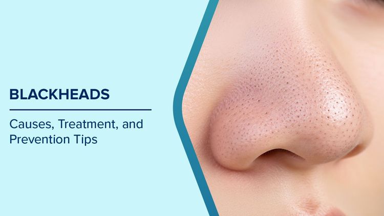 what are blackheads