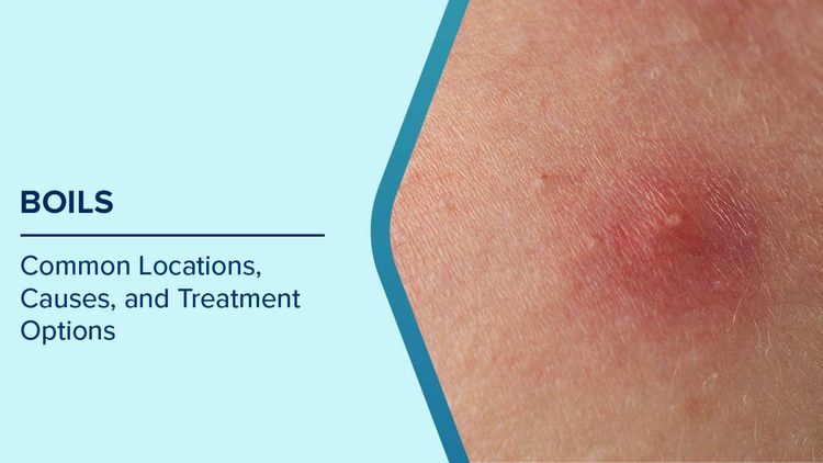 Boils Causes and Symptoms