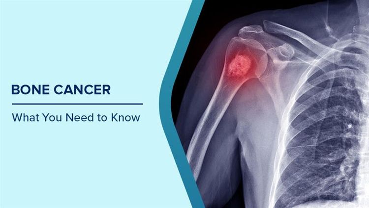 What is Bone Cancer