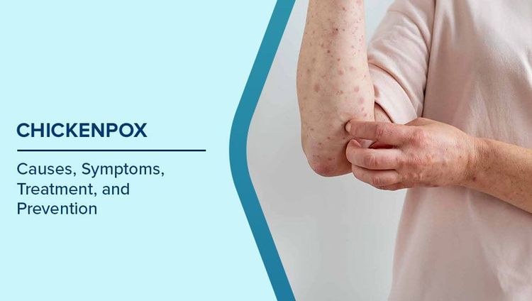 Chickenpox Symptoms