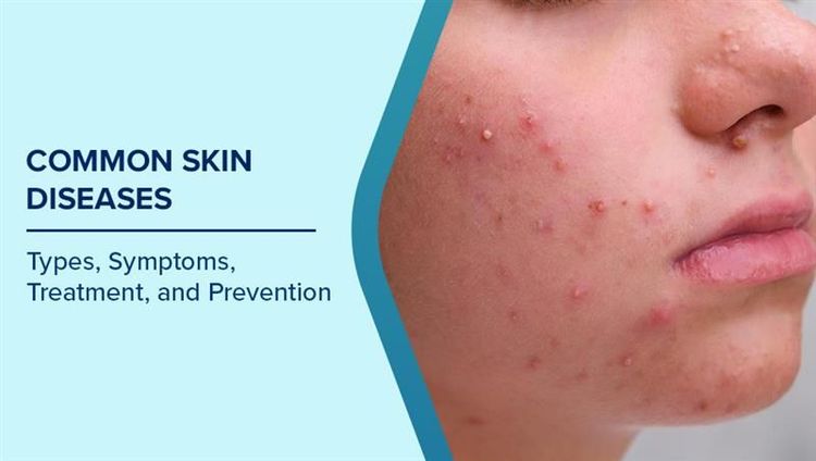Types of Skin Diseases