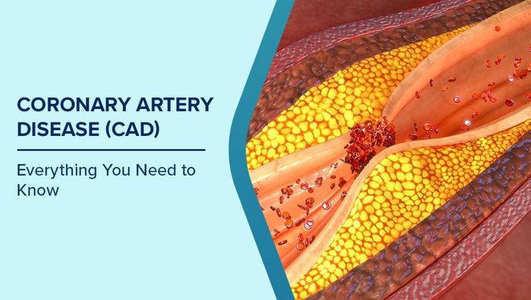 Coronary Artery Disease Symptoms
