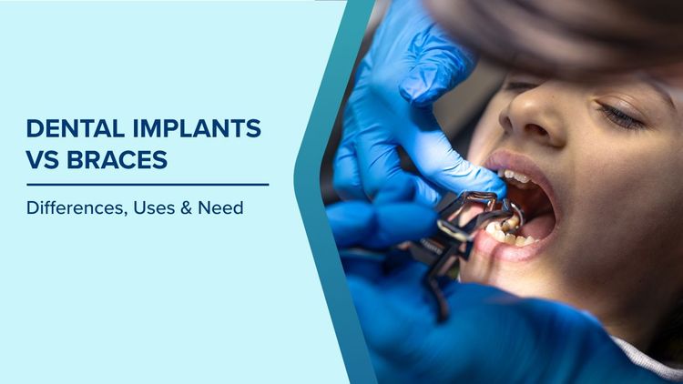 Difference Between Dental Implants and Braces