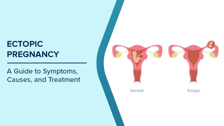 Ectopic Pregnancy Symptoms