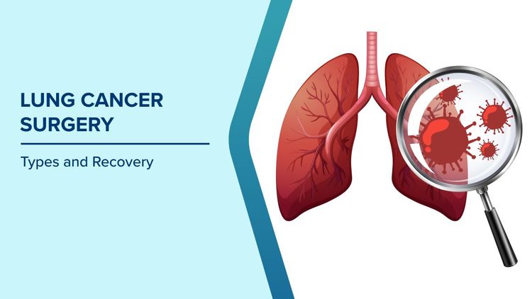 Types of Lung Cancer Surgery