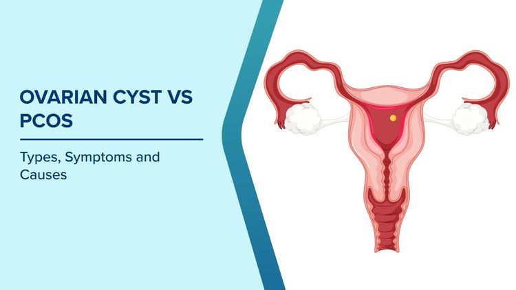 Symptoms of Ovarian Cyst and PCOS