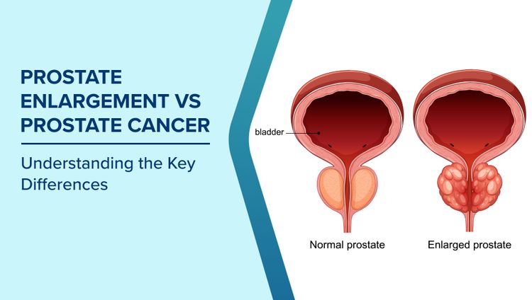 Prostate Enlargement vs Prostate Cancer
