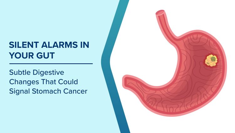 Early Signs of Stomach Cancer
