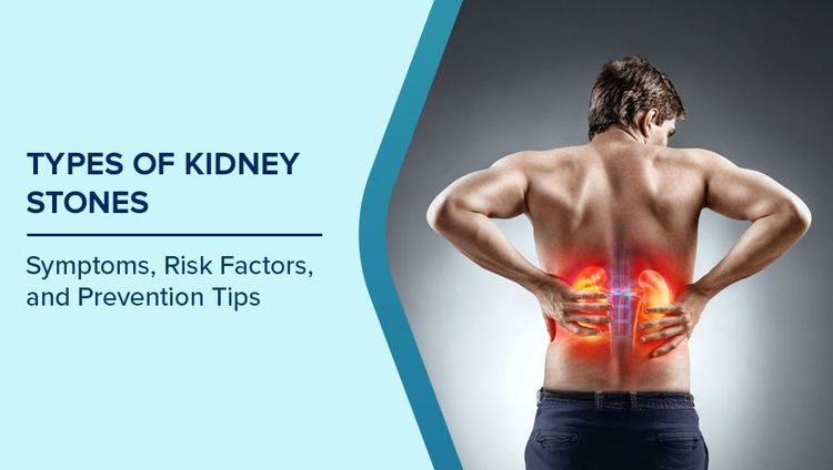 Types of Kidney Stones