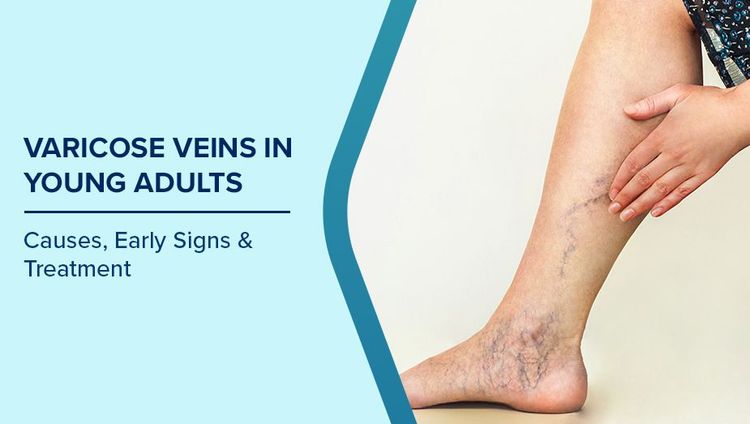 Causes of Varicose Veins in Young Adults