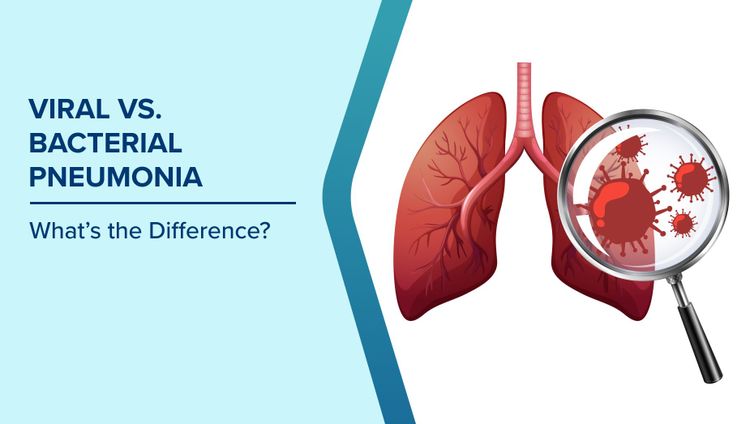 Viral & Bacterial Pneumonia Symptoms
