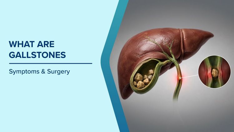 When Gallstones Become Serious