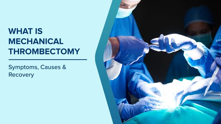 Mechanical Thrombectomy for Stroke