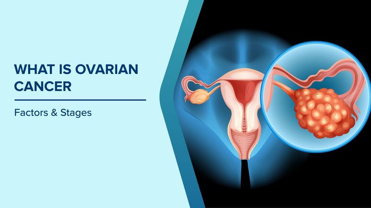 Stages of Ovarian Cancer