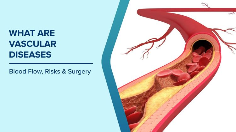 What are Vascular Diseases
