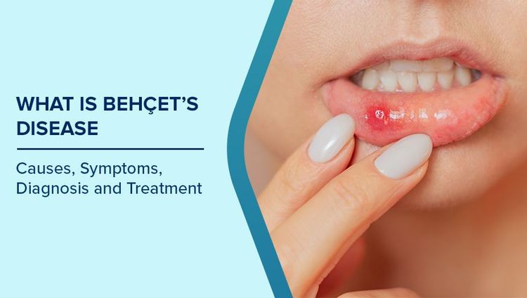 What is Behcet's Disease