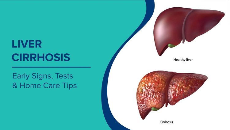 Cirrhosis of the Liver: Symptoms, Causes, Tests, Treatment and Diet