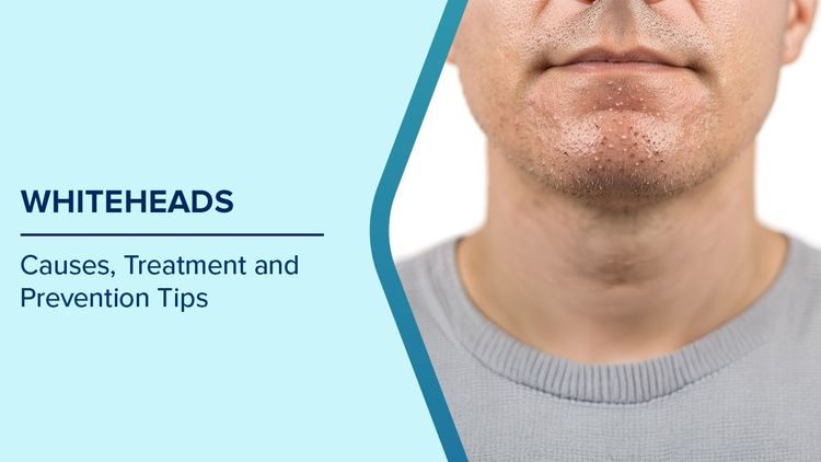 Causes of Whiteheads