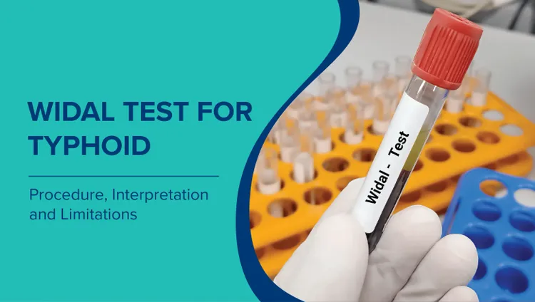 टाइफाइड के लिए विडाल परीक्षण (Widal Test in Hindi): प्रक्रिया, सामान्य सीमा, व्याख्या और सीमाएँ