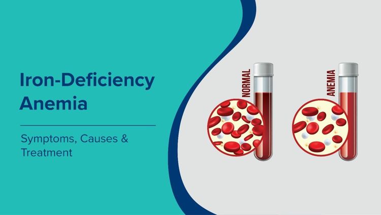आयरन की कमी से होने वाला एनीमिया (Iron Deficiency Anaemia in Hindi): लक्षण, कारण और उपचार