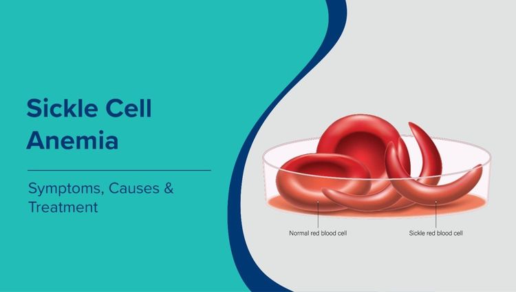 सिकल सेल एनीमिया (Sickle Cell Anemia in Hindi): लक्षण, कारण और उपचार