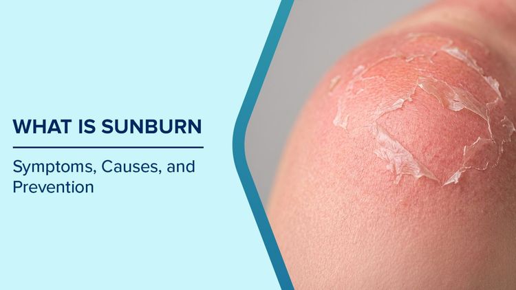 Symptoms of Sunburn